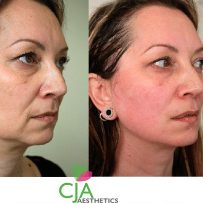 A Facelift Without Pain or Recovery Time?