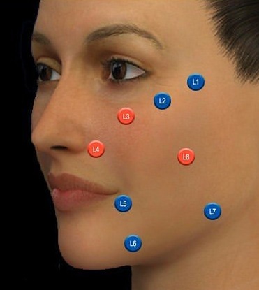 MD Codes for precise dermal fillers, the best dermal fillers in Southampton, Portsmouth MD Codes for precise dermal fillers, the best dermal fillers in Southampton, Portsmouth