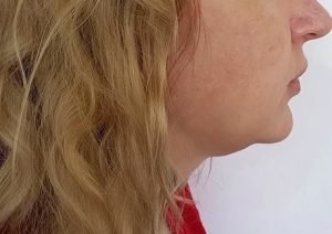 double chin treatments, the best aesthetics clinic in southampton