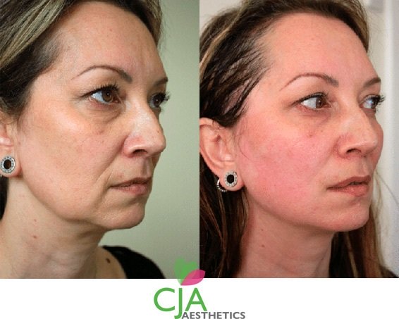 PDO Thread Lift Treatments, Former Jawline & Skin, Top Cosmetics Doctor in Southampton 