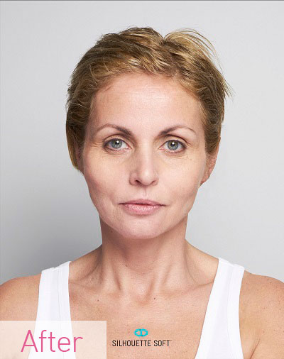 Thread-Lifts-Non-Surgical-Facelifts-Southampton-Portsmouth-Chichester-Winchester
