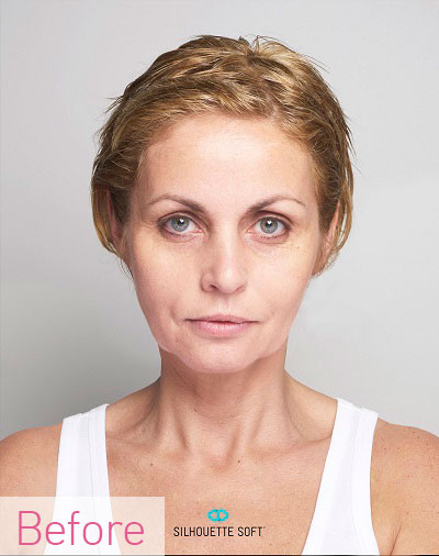 Thread-Lifts-Non-Surgical-Facelifts-Southampton-Portsmouth-Chichester-Winchester