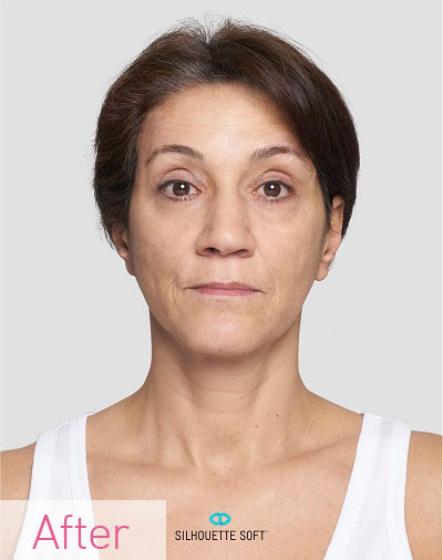 Thread-Lifts-non-Surgical-Facelifts-Southampton-Portsmouth-Chichester-Winchester