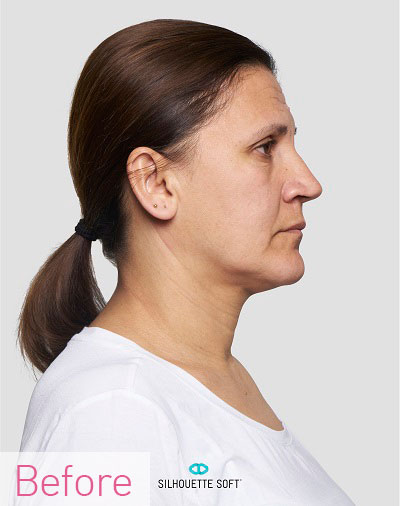 Thread-Lifts-Non-Surgical-Face-Lifts-Southampton-Portsmouth-Chichester-Winchester