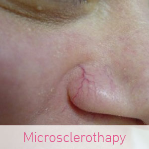 Microsclerotherapy Microsclerotherapy
