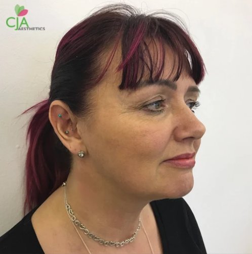 after anti-ageing treatments, cja aesthetics by Dr Chris Airey in Southampton