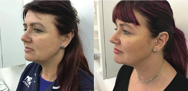 before and after non surgical facelift at cja aesthetics clinic in southampton
