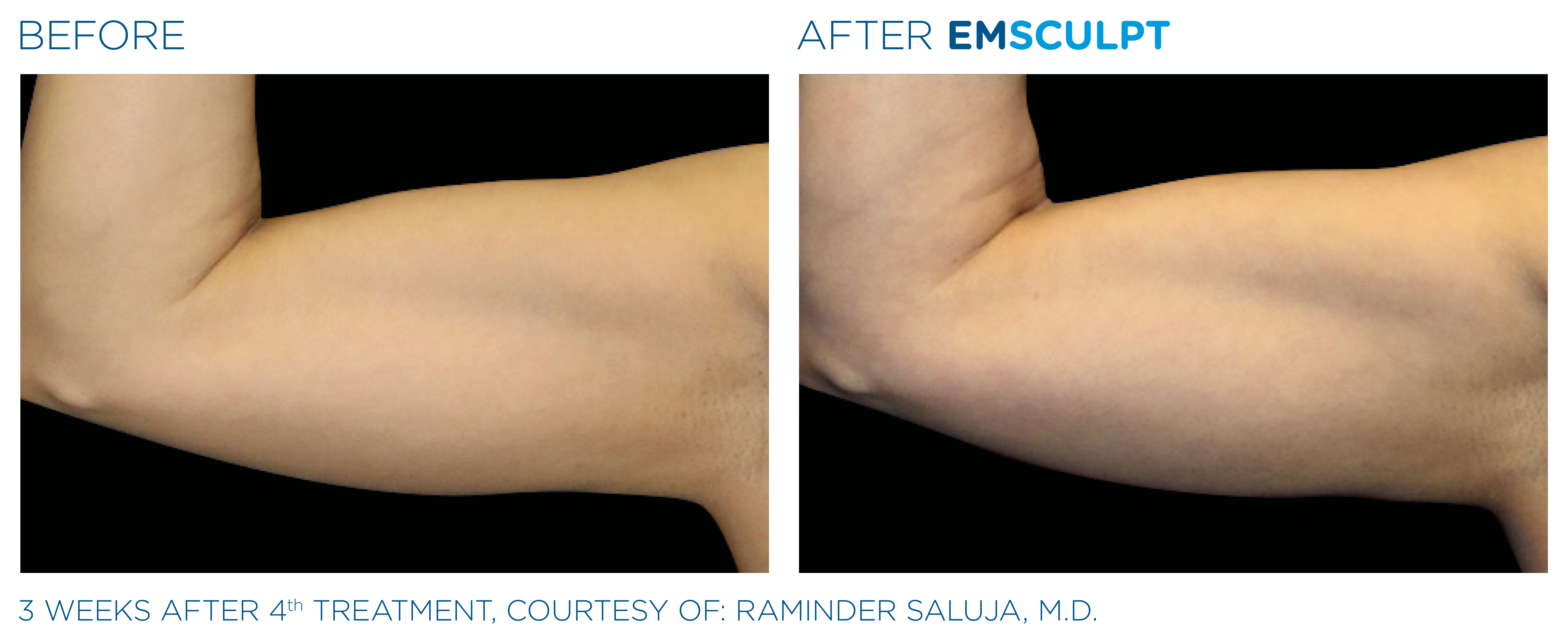 Increase Arm Strength with EMSCULPT Hampshire aesthetics Clinics Increase Arm Strength with EMSCULPT Hampshire aesthetics Clinics