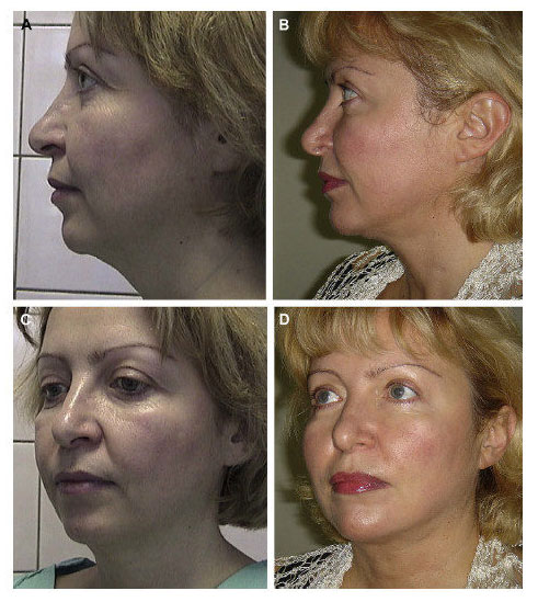 xNon Surgical Face lift Aptos Thread Lifts Before and After images CJA Aesthetics Southampton 2 e1618492682382.jpg.pagespeed.gpjpjwpjwsjsrjrprwricpmdim100.ic .0RsKsz7V76