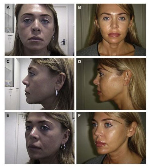 xNon Surgical Face lift Aptos Thread Lifts Before and After images CJA Aesthetics Southampton e1618492807150.jpg.pagespeed.gpjpjwpjwsjsrjrprwricpmdim100.ic .3suXhfjQ5u