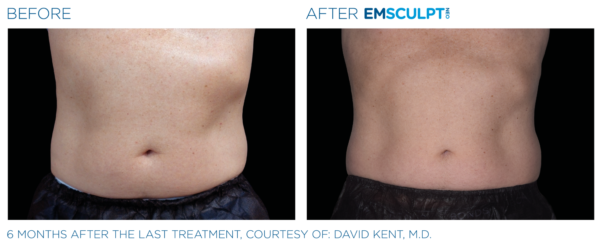 EMSCULPT NEO Body Sculpting in Southampton, CJA Aesthetics