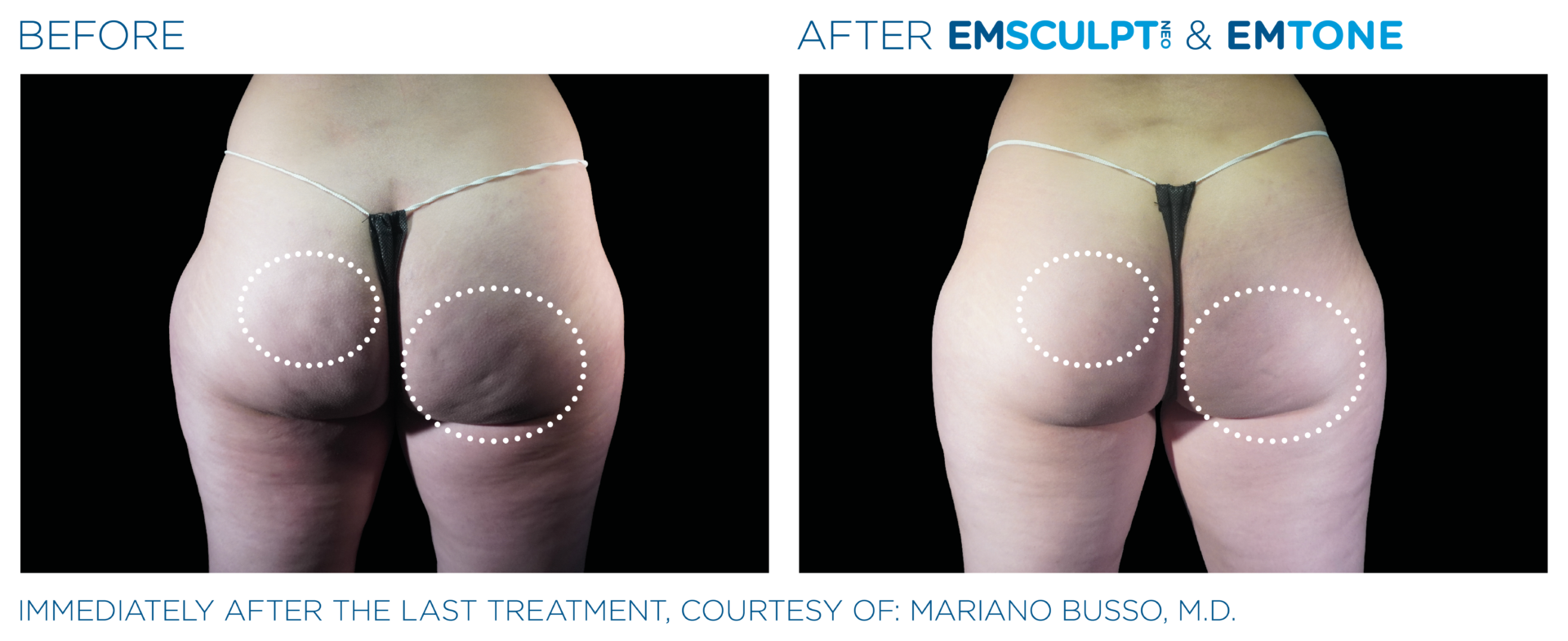 EMSCULPT NEO BODY CONTOURING IN SOUTHAMPTON