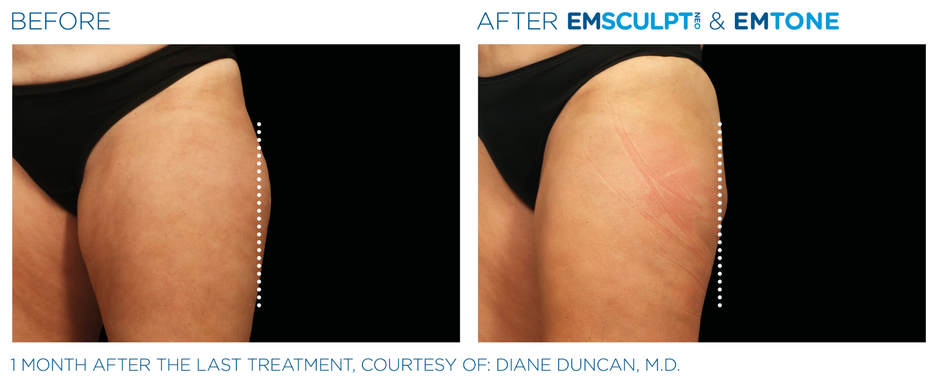 EMSCULPT NEO BODY CONTOURING IN SOUTHAMPTON