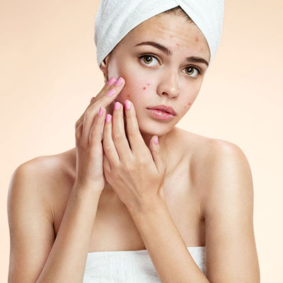 Top Tips For Treating Acne