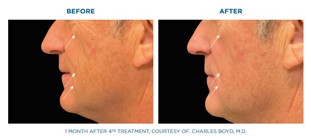before and after cheek lift with Emface