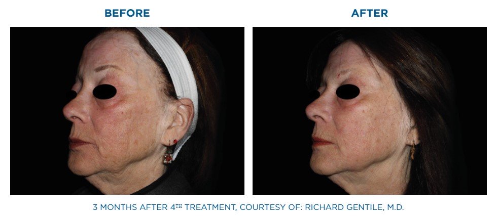 EMFACE before and after non invasive facial lifting