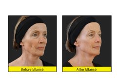 Ellanse-anti-aging-fillers-before-and-after-images