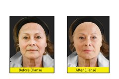 Reduce-wrinkles-with-Ellanse-Dermal-Fillers-at-CJA-Aesthetics-Southampton