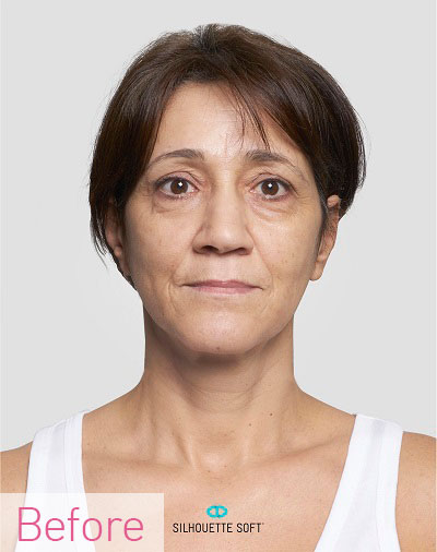 Thread-Lifts-non-Surgical-Facelifts-Southampton-Portsmouth-Chichester-Winchester
