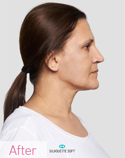 Thread-Lifts-non-Surgical-Facelifts-Southampton-Portsmouth-Chichester-Winchester