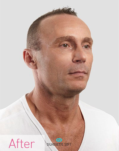 Thread Non Surgical Face Lifts Southampton Hampshire Aesthetics Clinics