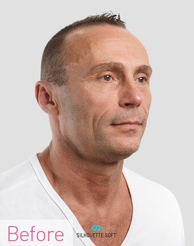 Thread-Lifts Non-Surgical-Facelifts-Southampton-Portsmouth-Chichester-Winchester