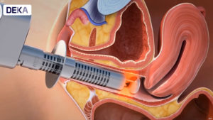 Vulvo vaginal atrophy treatment DEKA Technologies