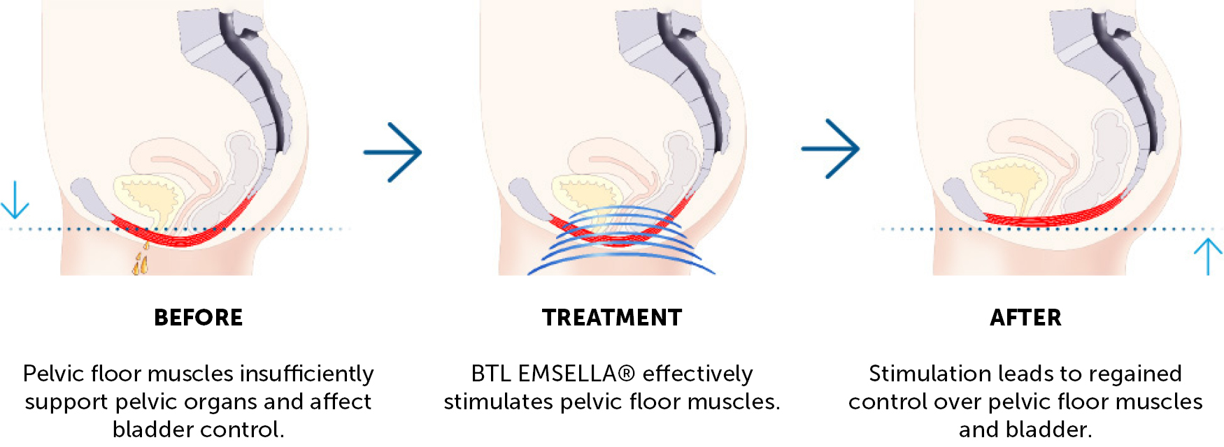 Emsella Incontinence Treatments in Southampton at CJA Aesthetics Clinics, Hampshire