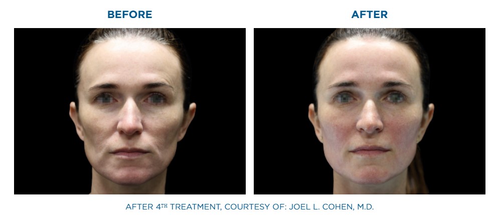 Emface non surgical facelift Southampton