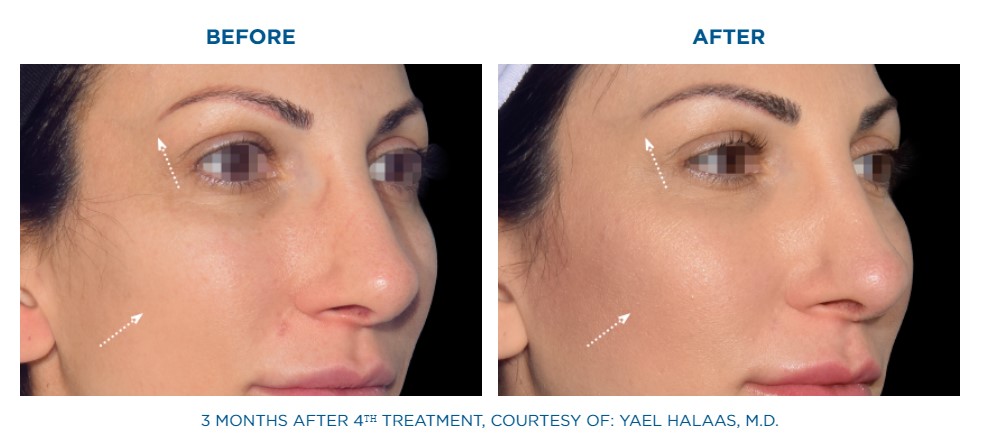 before and after emface facial lift