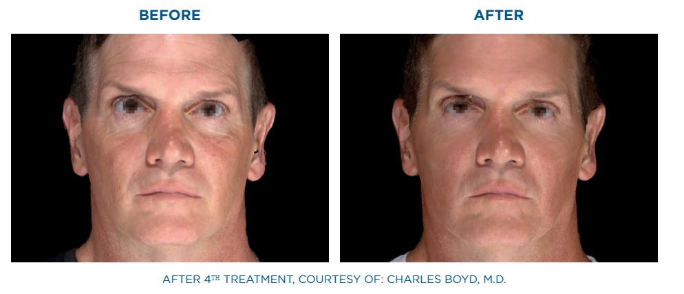 before and after emface facial lift