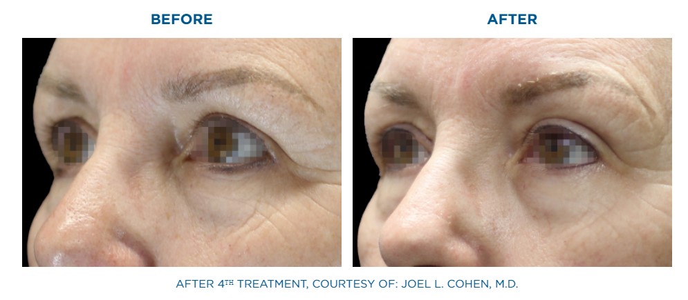 before and after emface facial lift