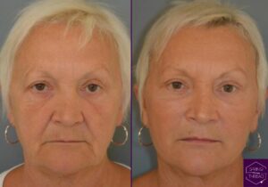Before and After Spring Thread Lift 1