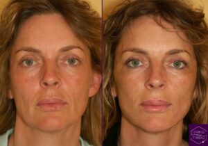 Before and After Spring Thread Lift 2