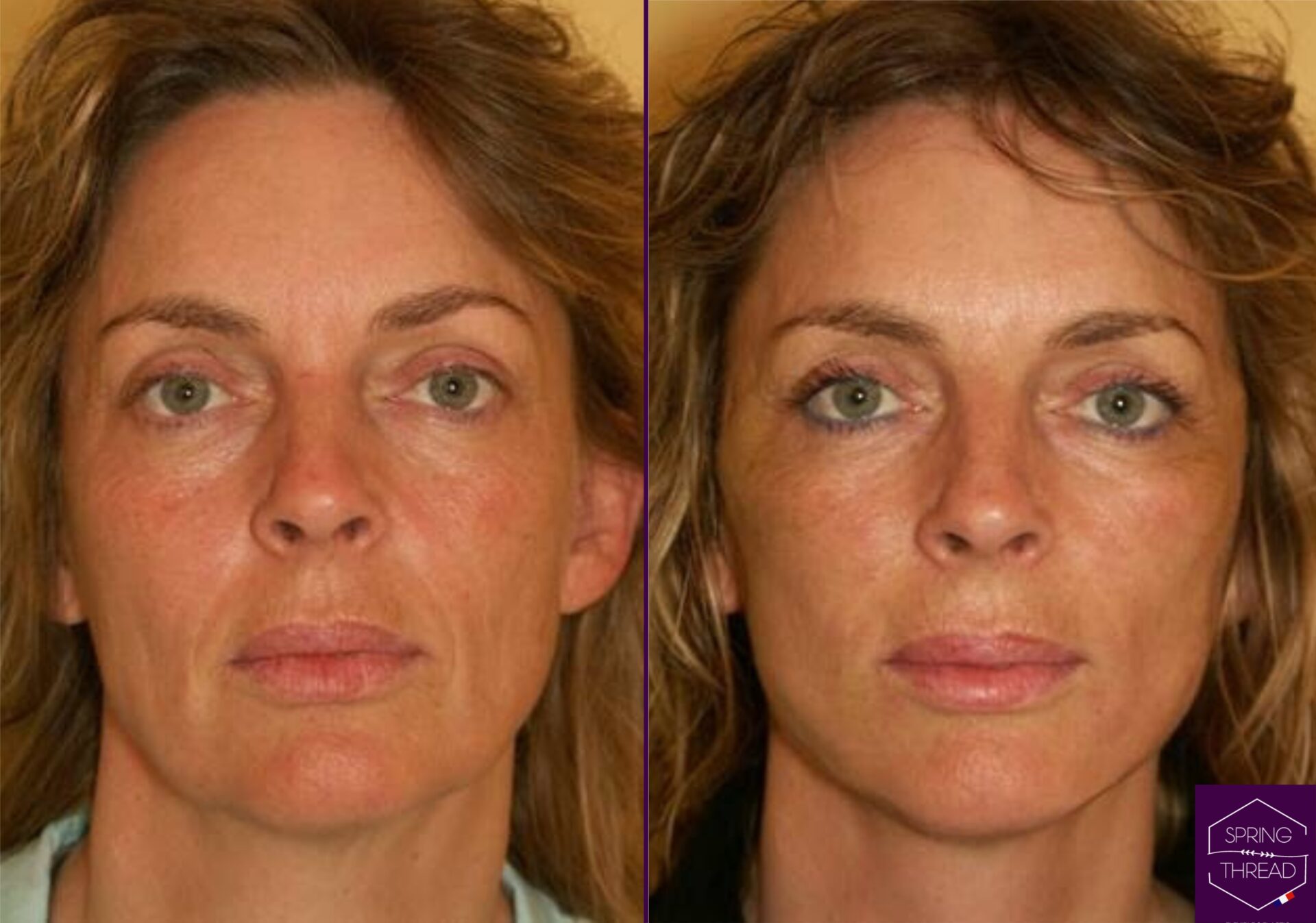 Spring Thread Lift Before and After Spring Thread Lift Before and After