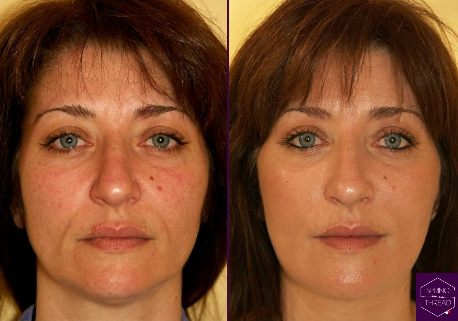 Spring Thread Lift Before and After 1 Spring Thread Lift Before and After 1