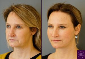 Before and After Spring Thread Lift 