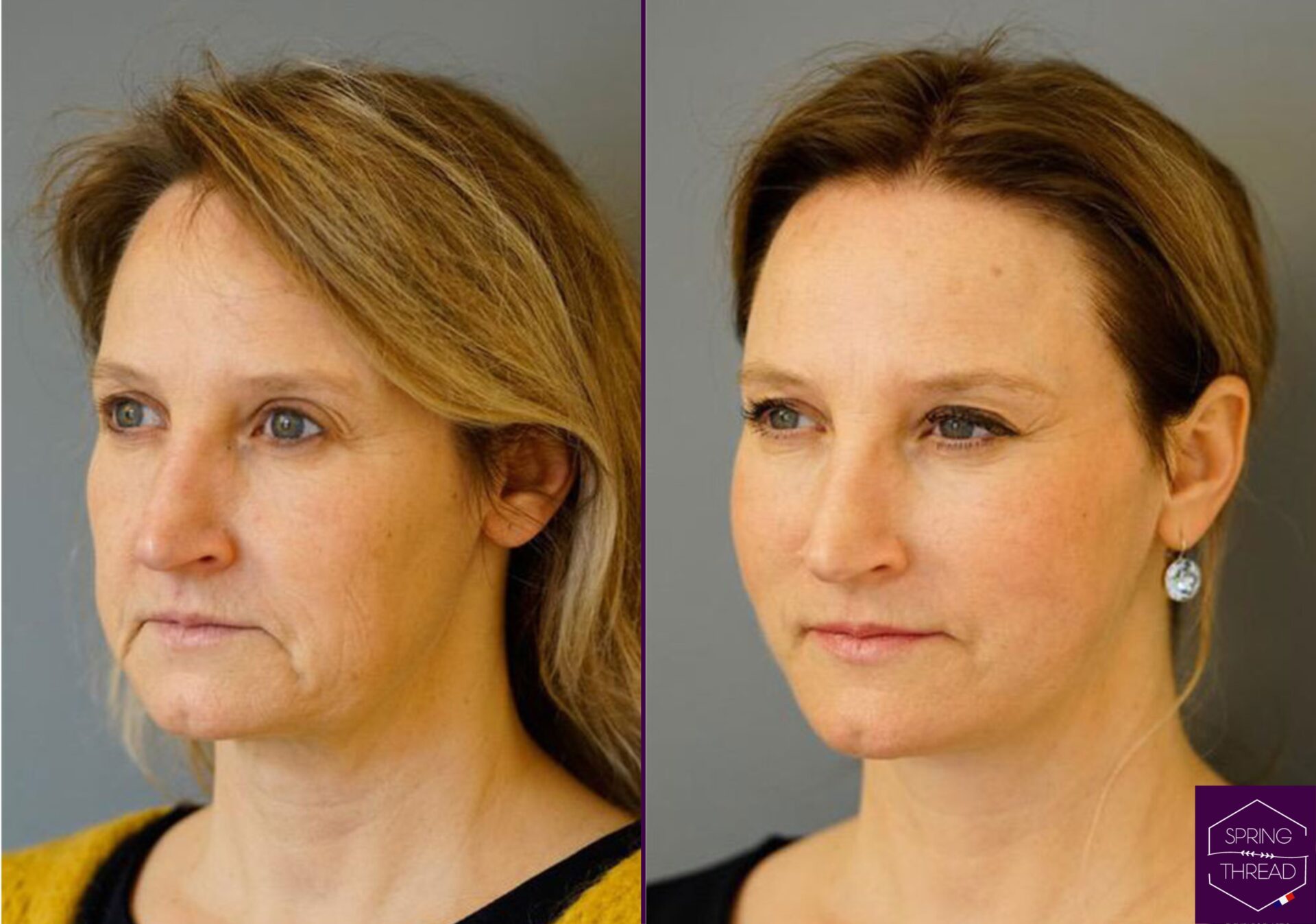 Spring Thread Lift Before and After 1 Spring Thread Lift Before and After 1