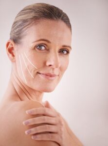 Woman showing thread tracks Spring Thread Lift Southampton Clinic