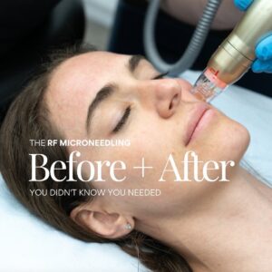 Sylfirm X RF Microneedling Southampton Clinic (4)