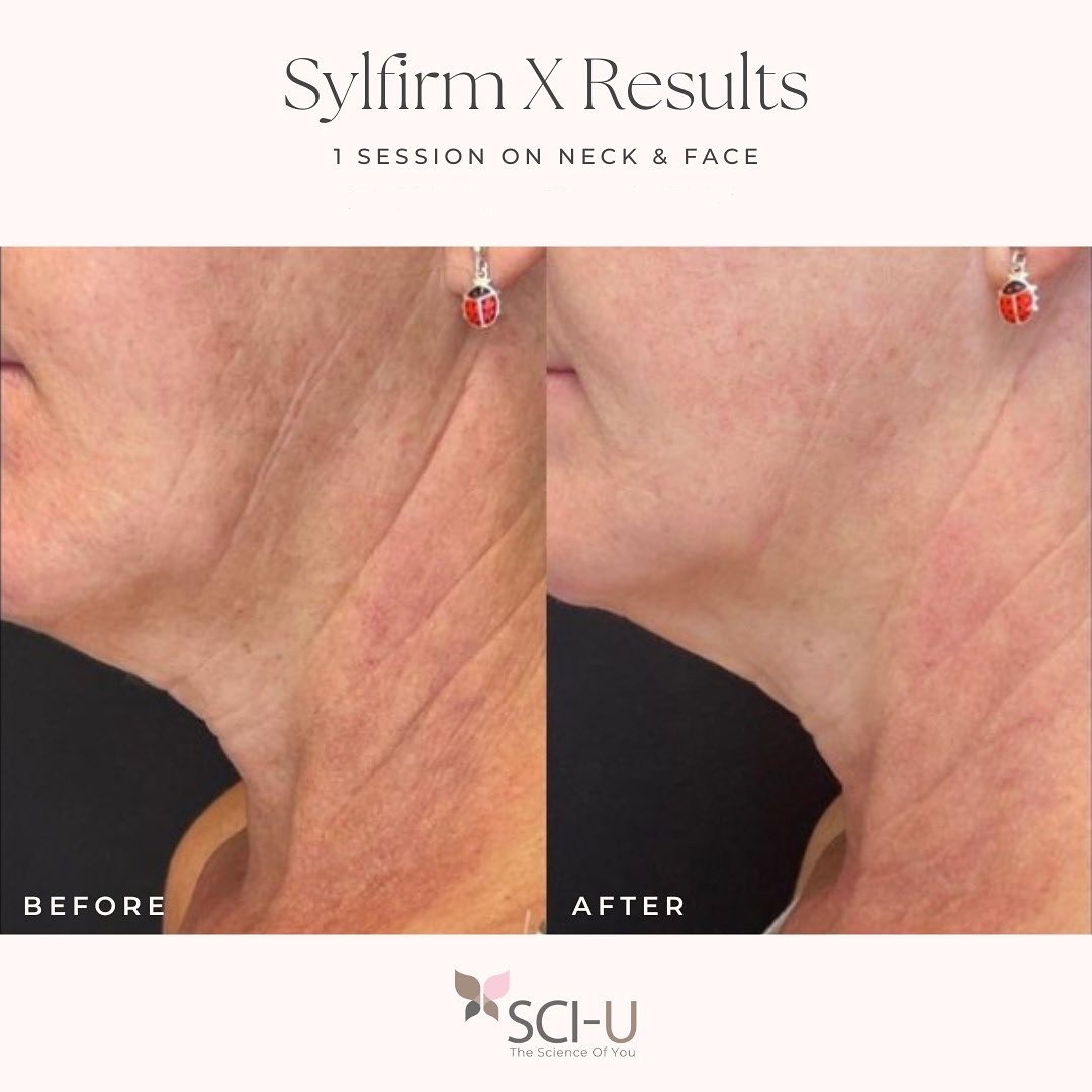 Sylfirm X RF Microneedling Southampton Clinic CJA Sylfirm X RF Microneedling Southampton Clinic CJA
