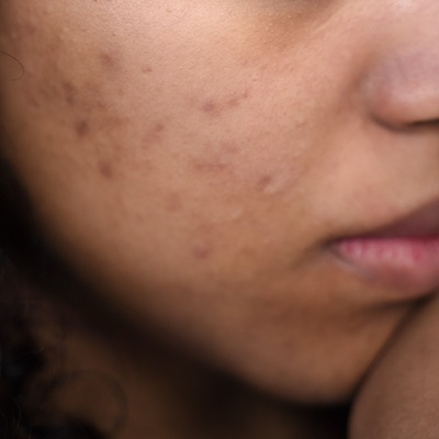 Acne solutions at clinics in Hampshire Acne solutions at clinics in Hampshire
