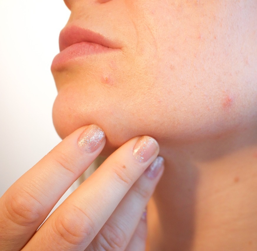 Acne treatments that work CJA aesthetics clinics in Hampshire Acne treatments that work CJA aesthetics clinics in Hampshire