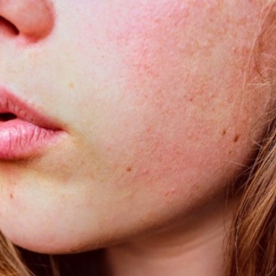 Acne Acne