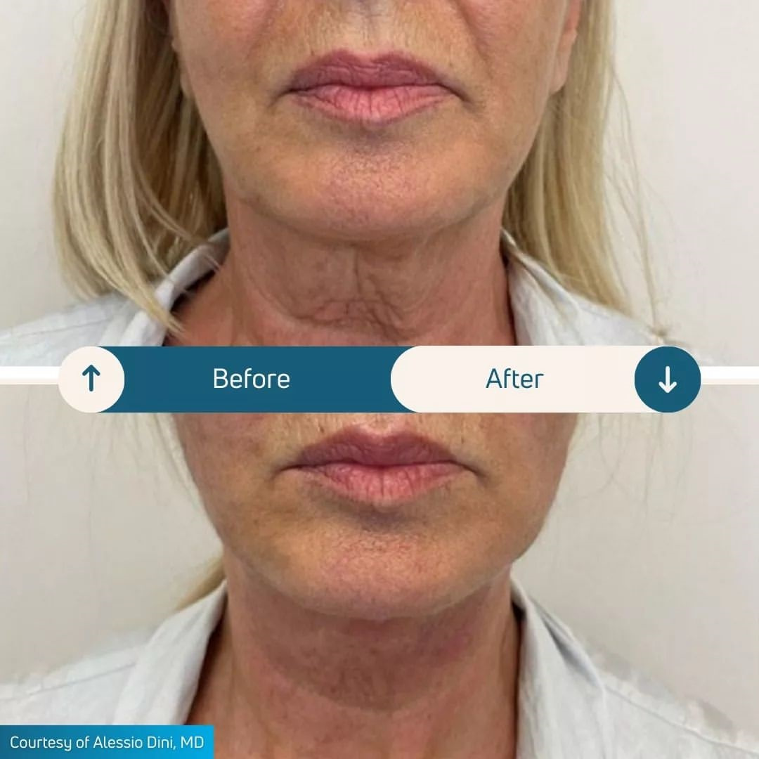 Endolift laser skin tightening Southampton Before and After Endolift Treatment