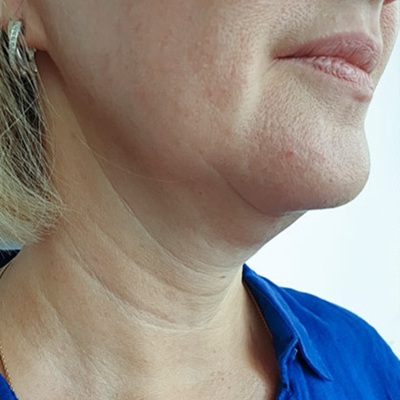 Double Chin