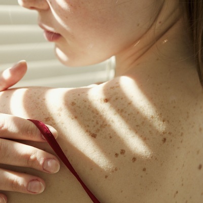 Hyperpigmentation Hyperpigmentation