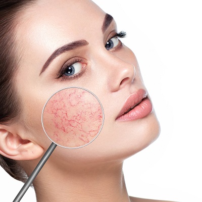 Best rosacea treatments near me Best rosacea treatments near me