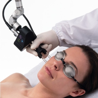 Deka laser mole removal treatments in Hampshire Deka laser mole removal treatments in Hampshire