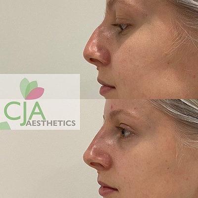 non surgical rhinoplasty nose job near me non surgical rhinoplasty nose job near me